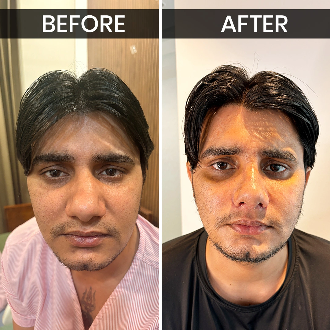 Before After