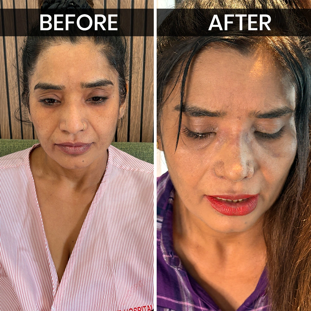 Before After