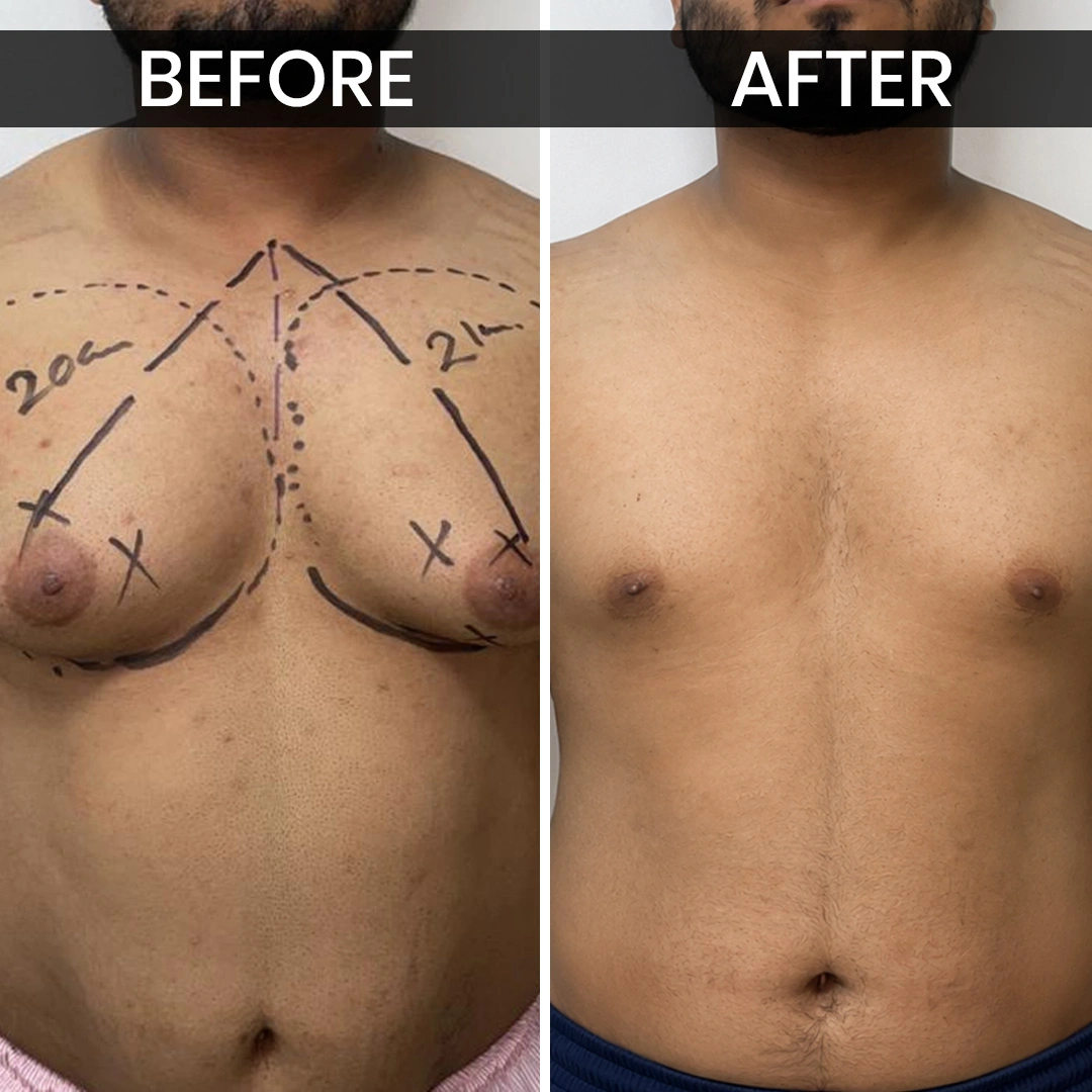 Before After