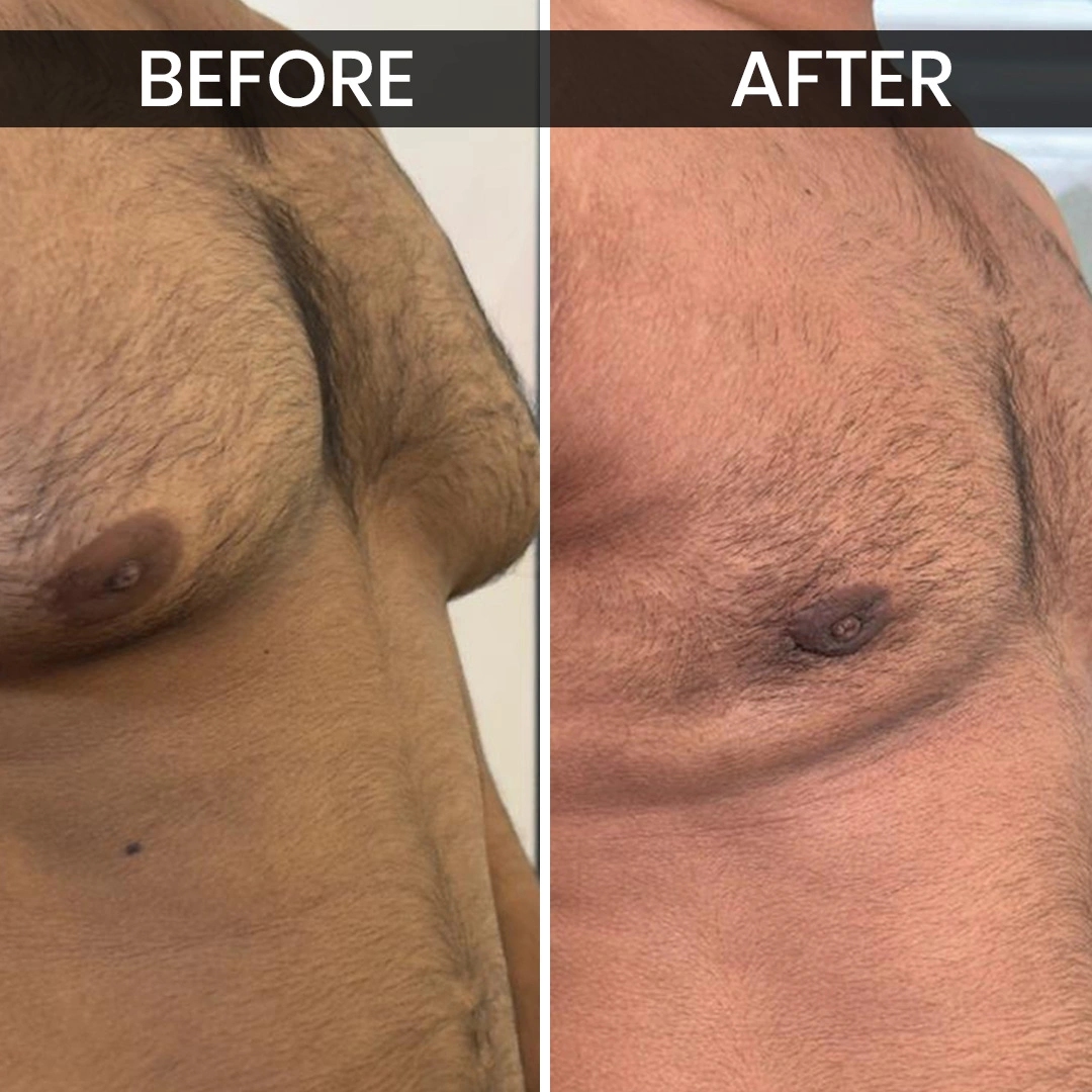 Before After