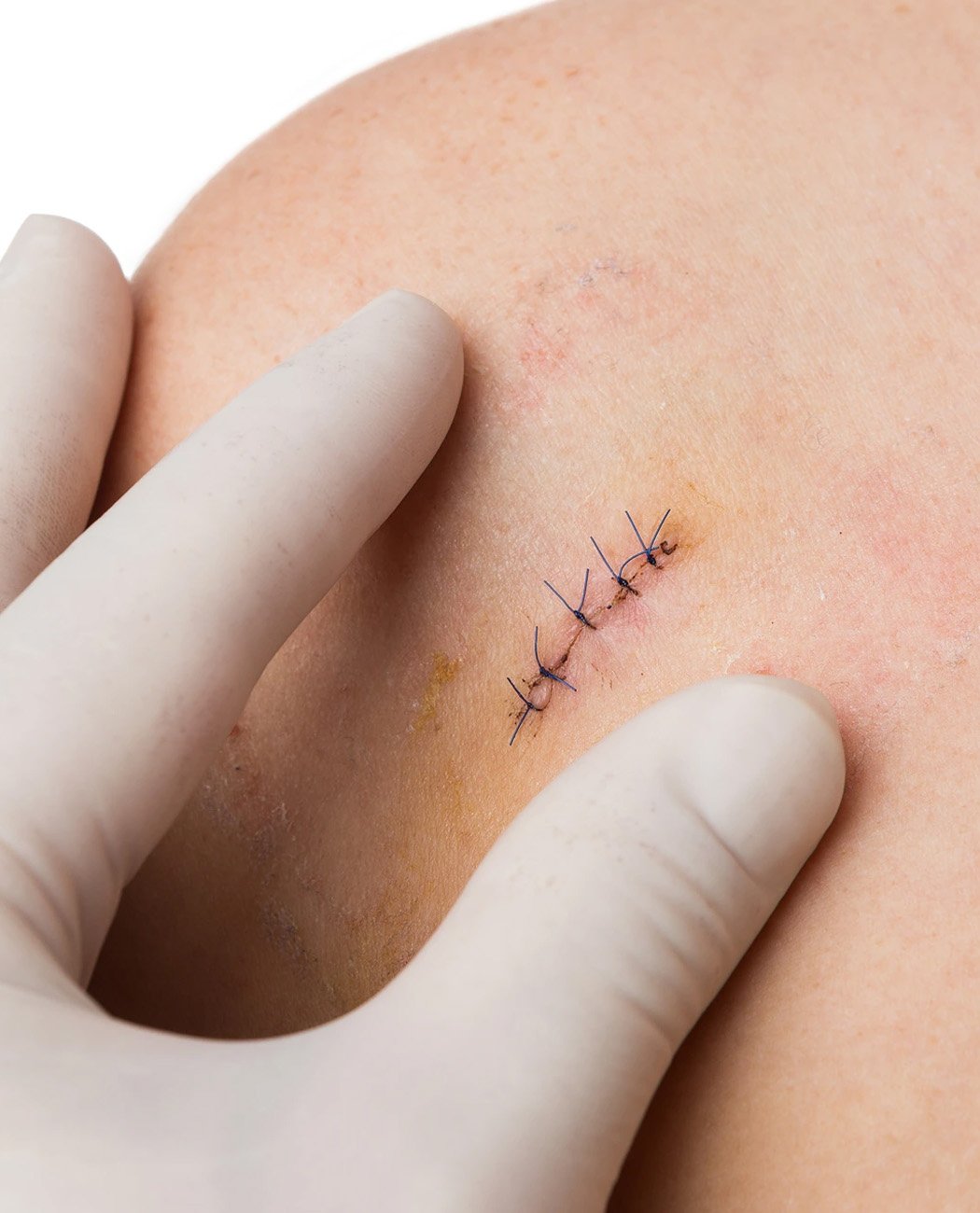 Who is an Ideal Candidate for Facial Fat Grafting?