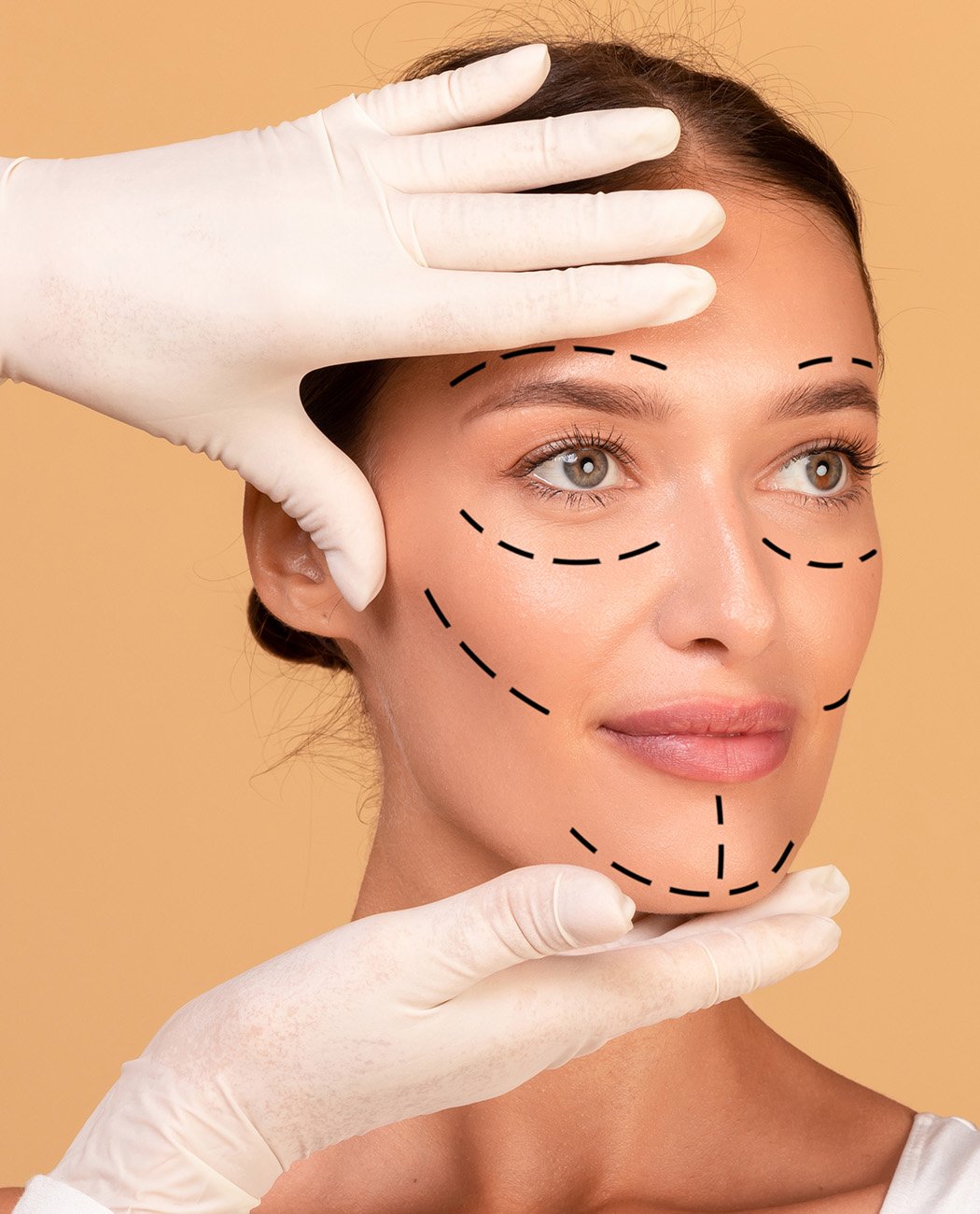 How is Facial Fat Grafting Performed?