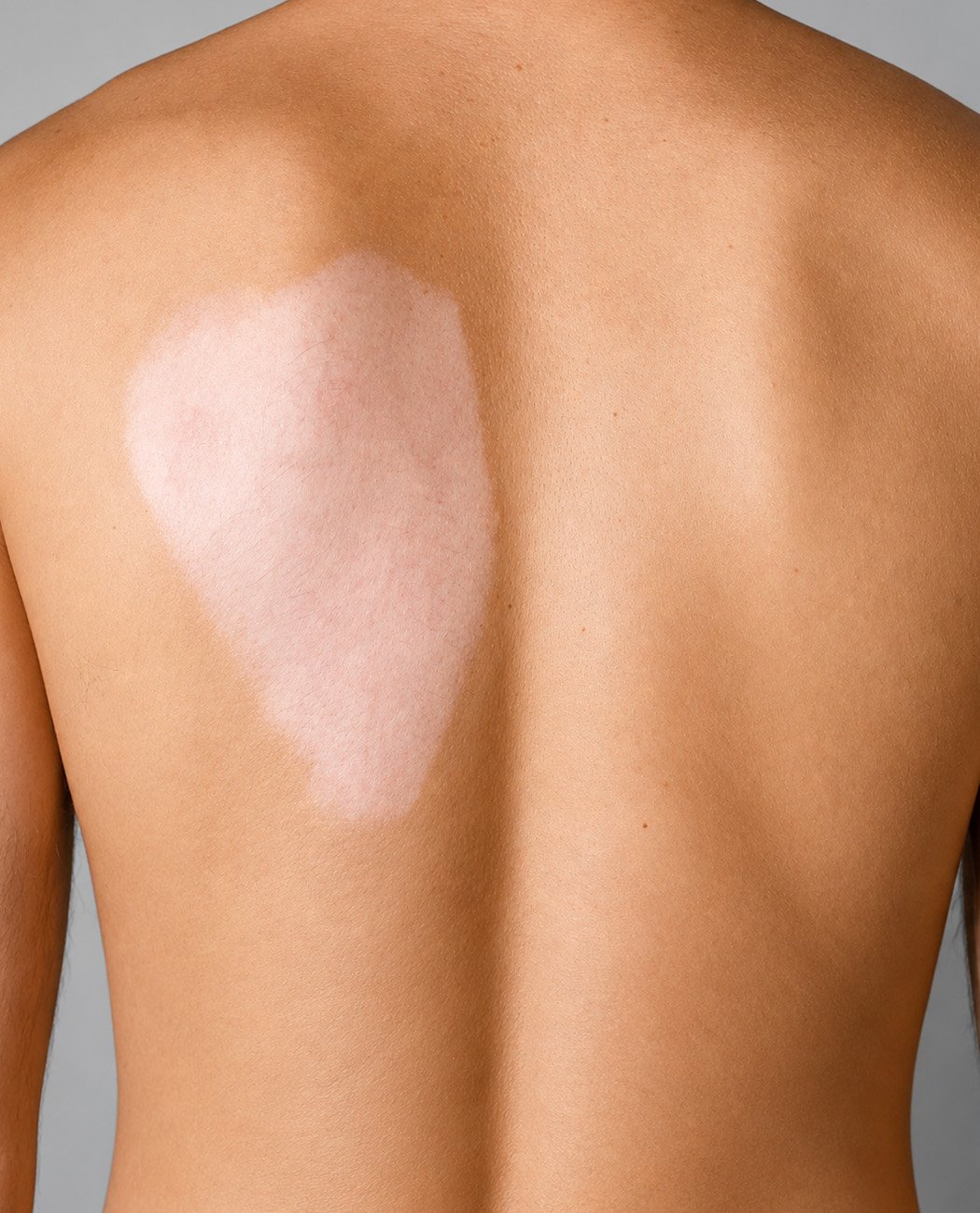 Recovery After Facial Fat Grafting: What to Expect