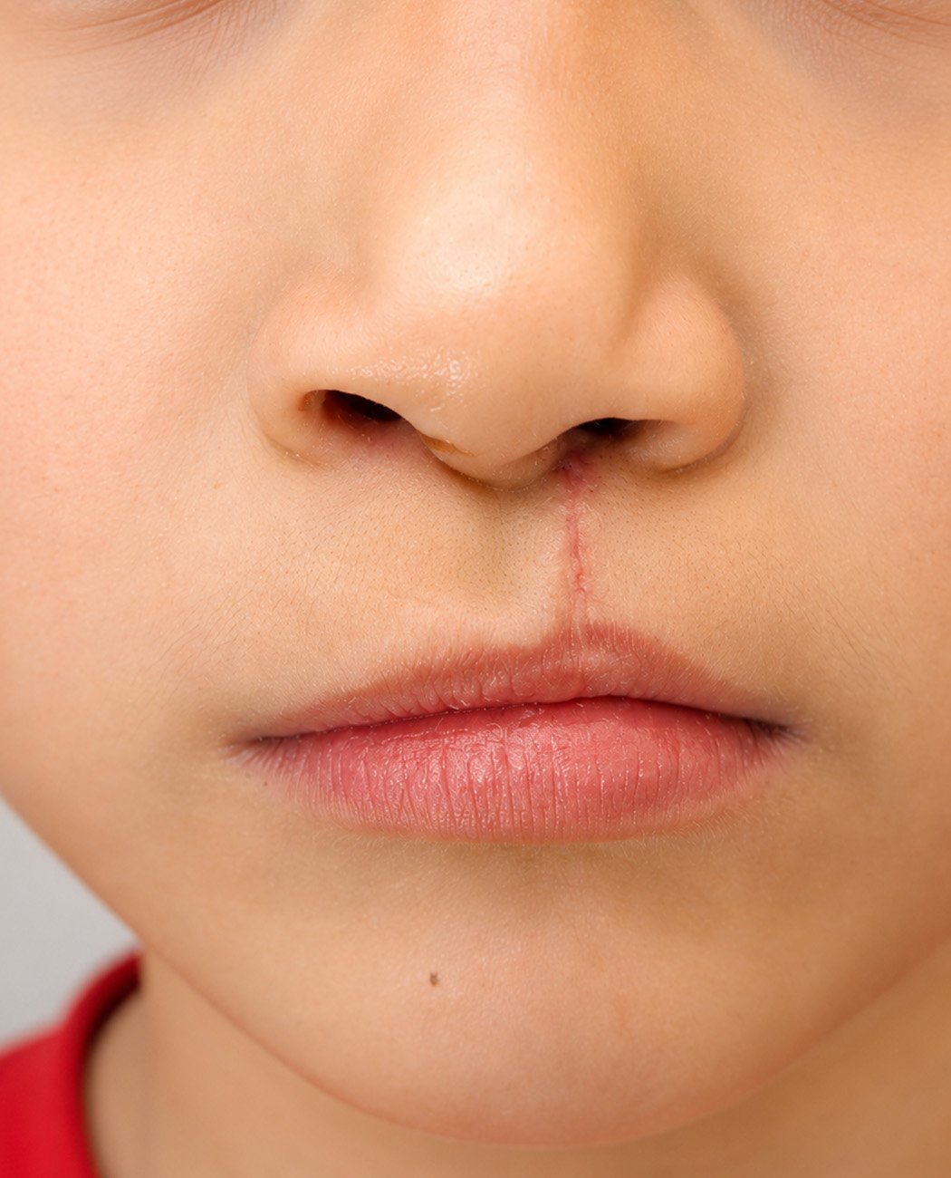 Who is an Ideal Candidate for Lip Filler Treatment?