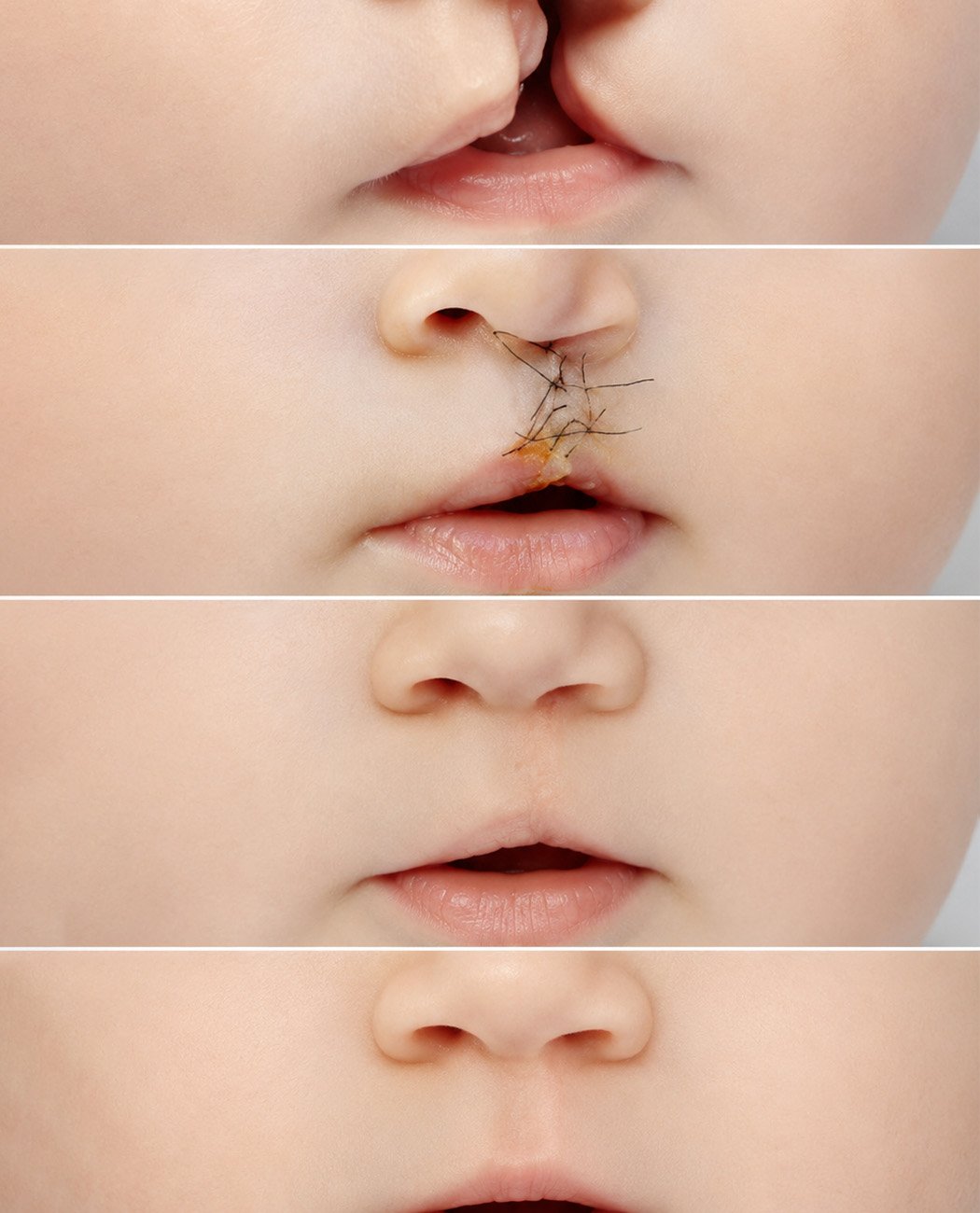 How is Lip Filler Treatment Performed?