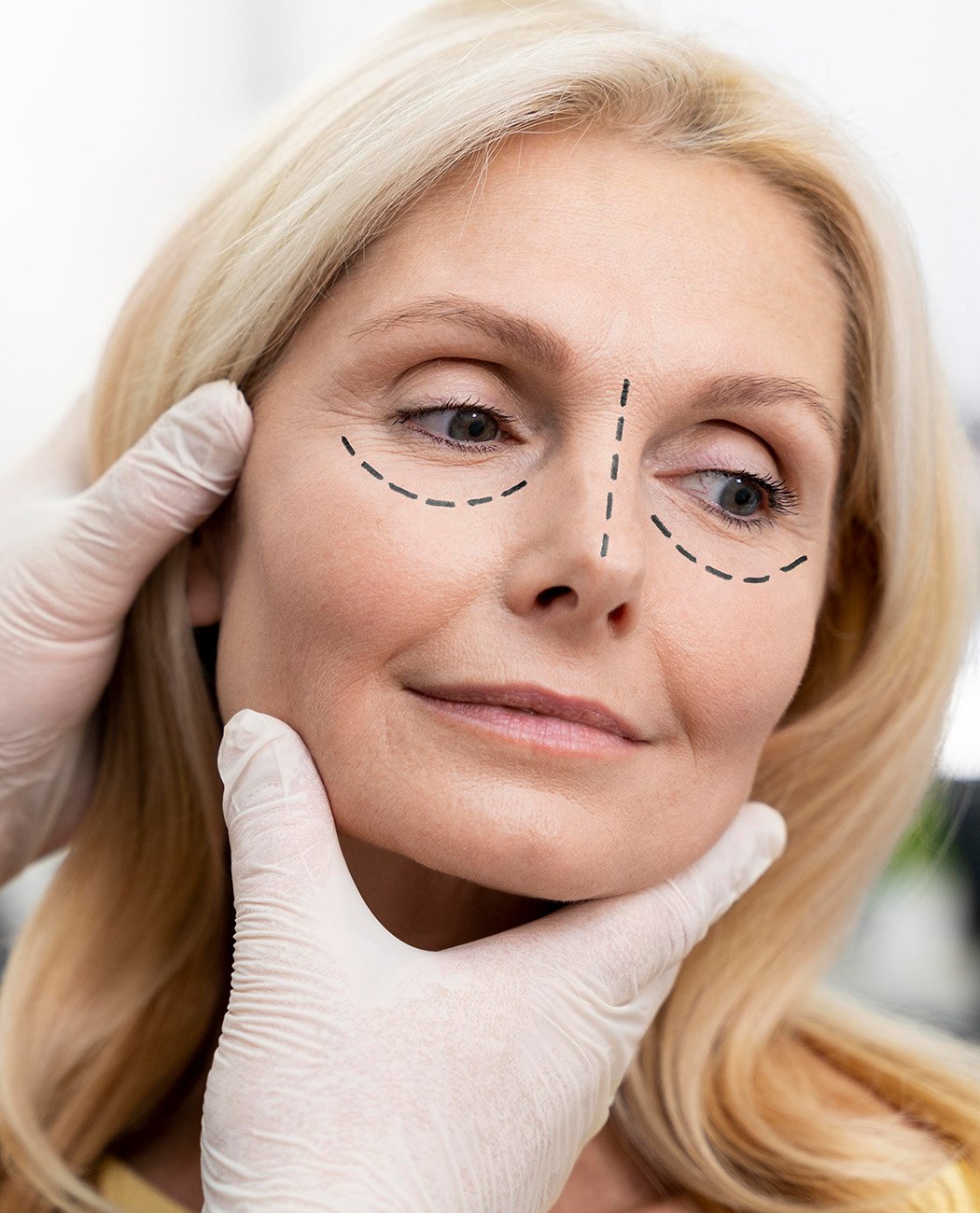 How is Blepharoplasty surgery performed?