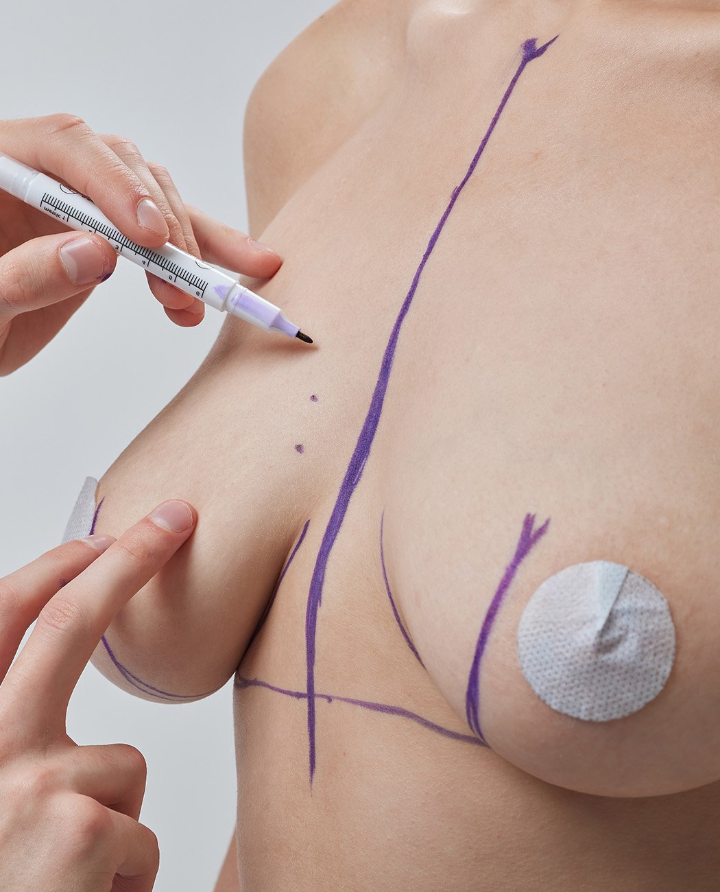 Who is an Ideal Candidate for Breast Lift Surgery?