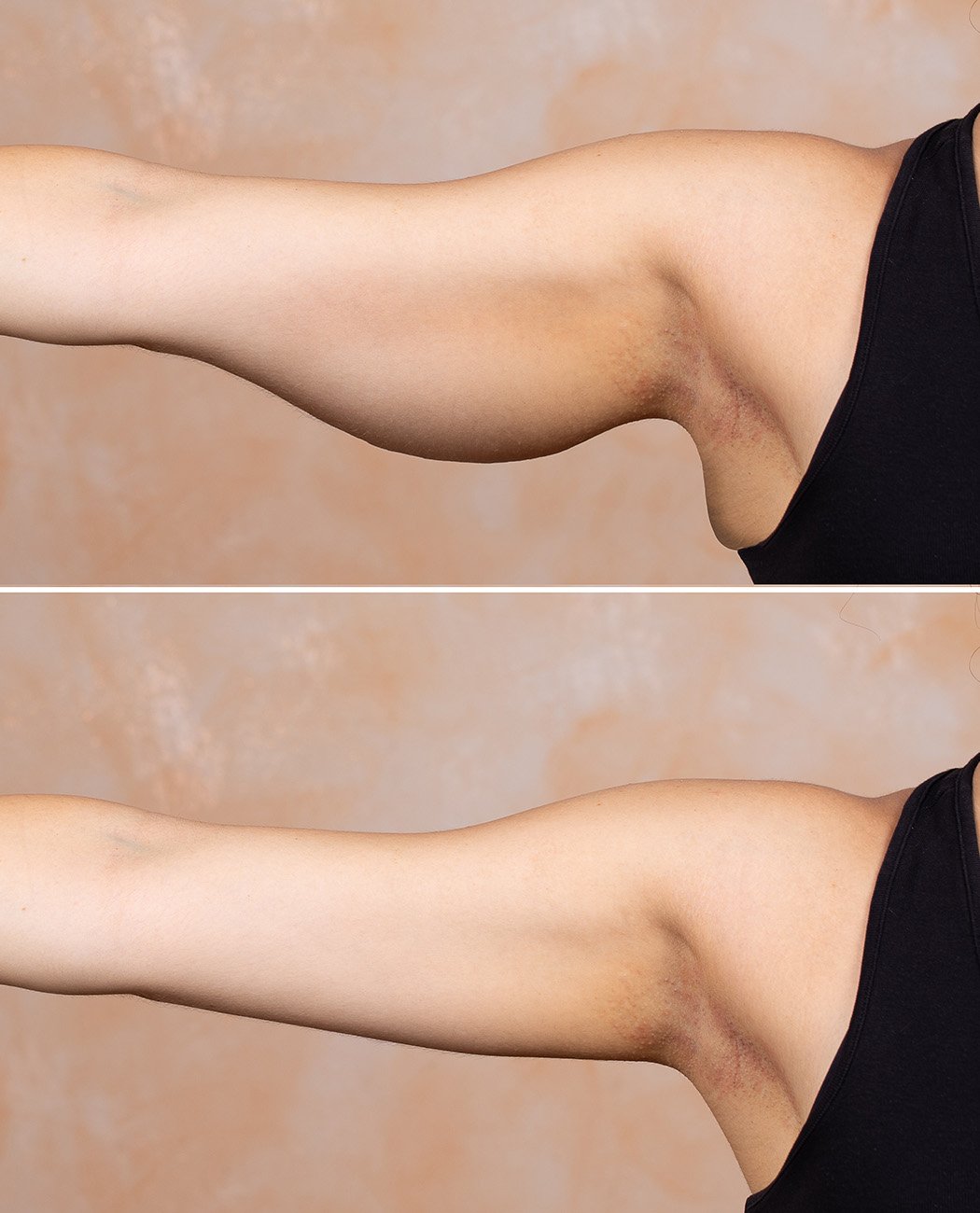 Who is an Ideal Candidate for an Arm Lift Surgery?