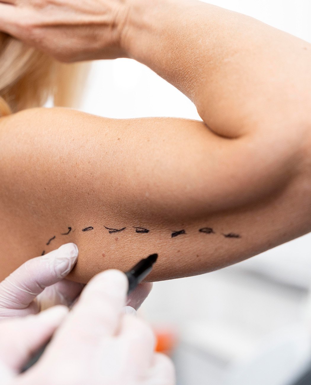 How is Arm Lift Surgery Performed?
