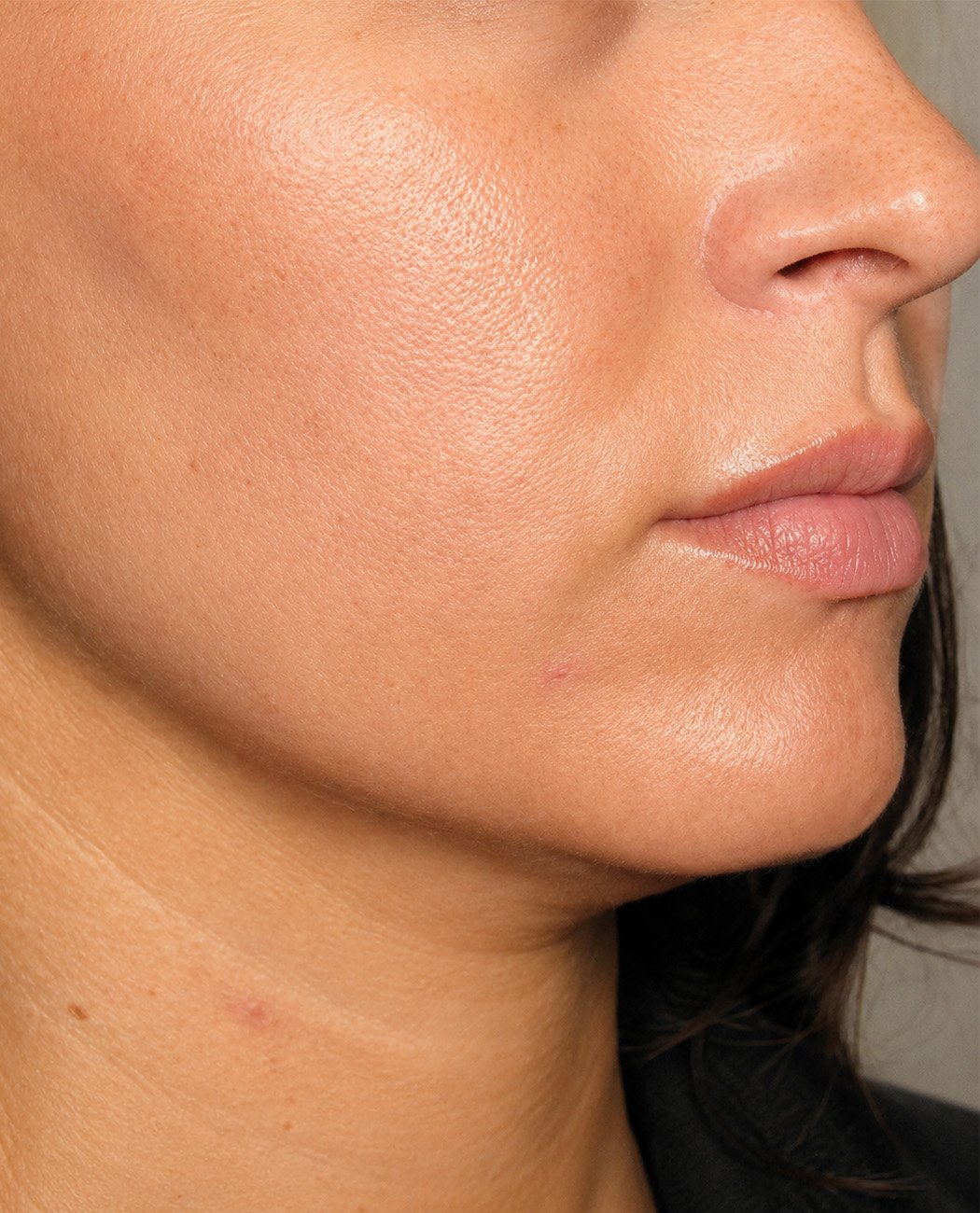 How is Skin Tightening (HIFU/RF) treatment performed?