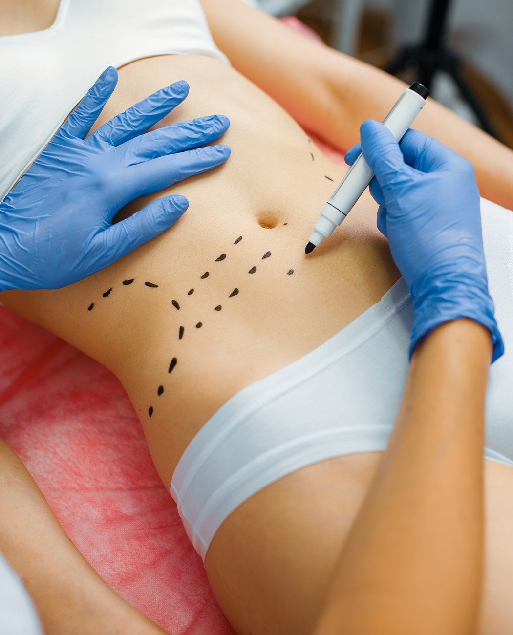 How is Mommy Makeover Surgery Performed?