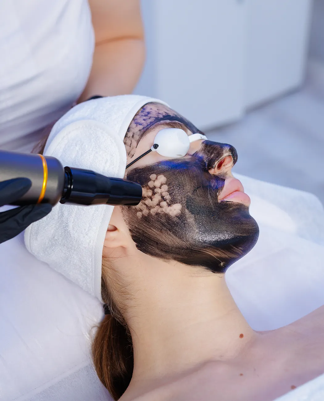 What is Carbon Laser Peel Treatment?