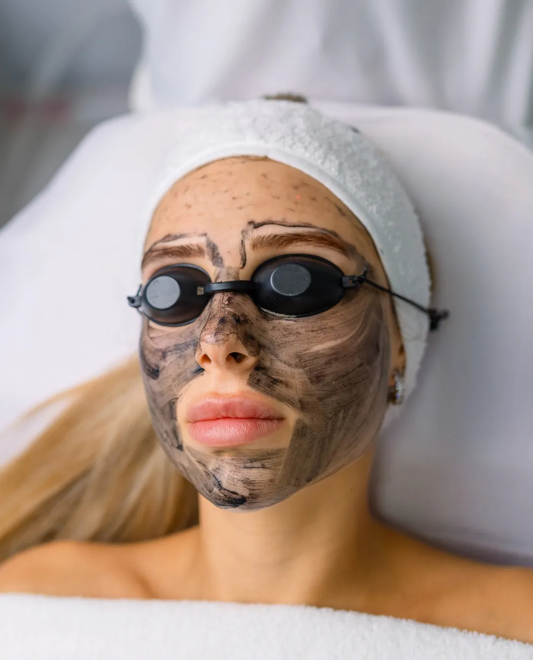 Recovery After Carbon Laser Peel Treatment: What to Expect