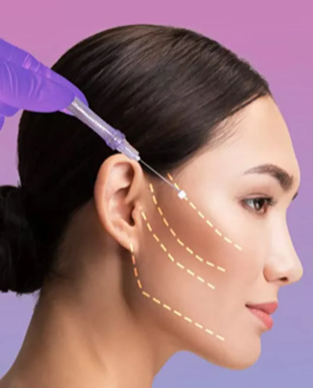 What is Thread Lift Surgery?