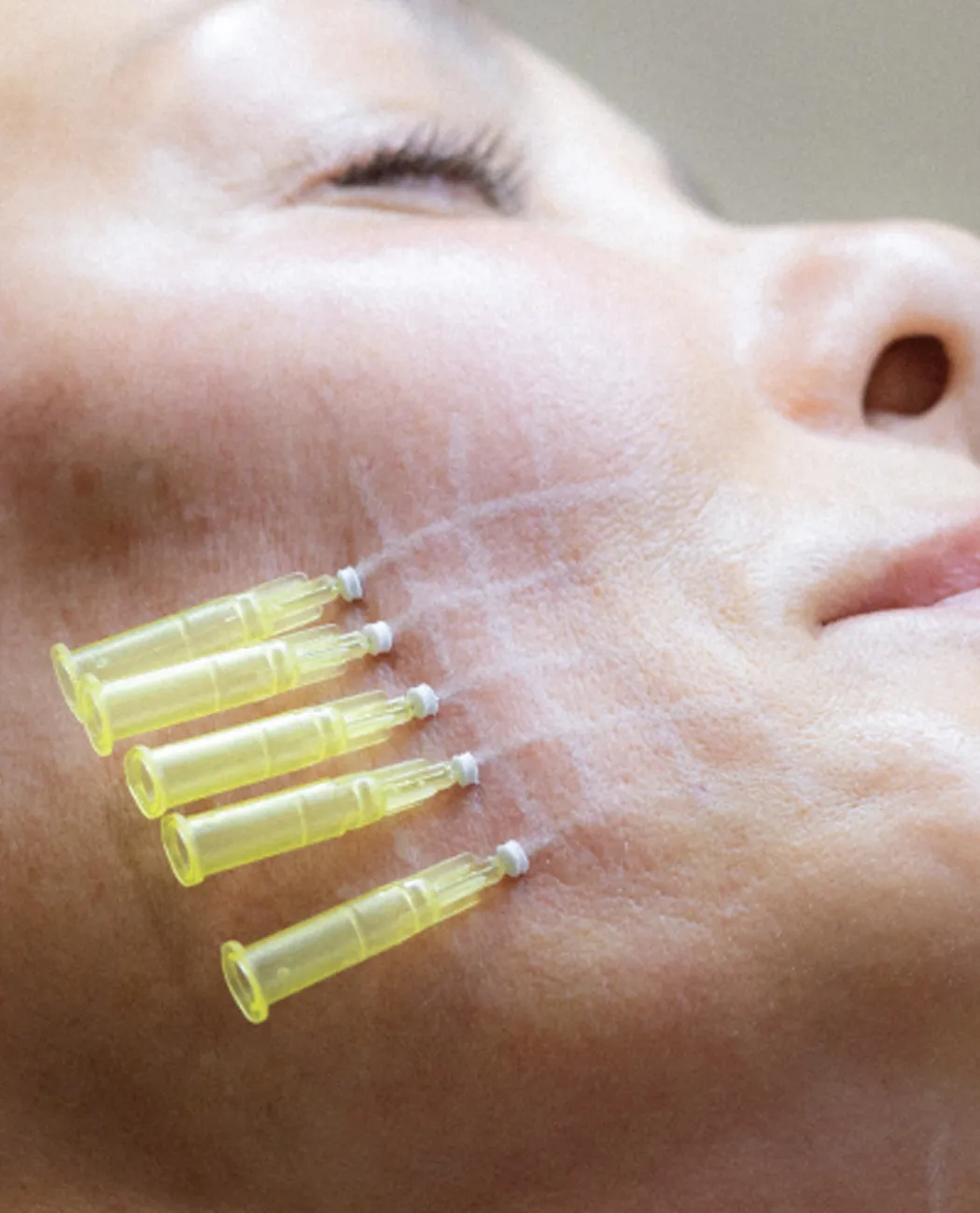 How is Thread Lift surgery performed?