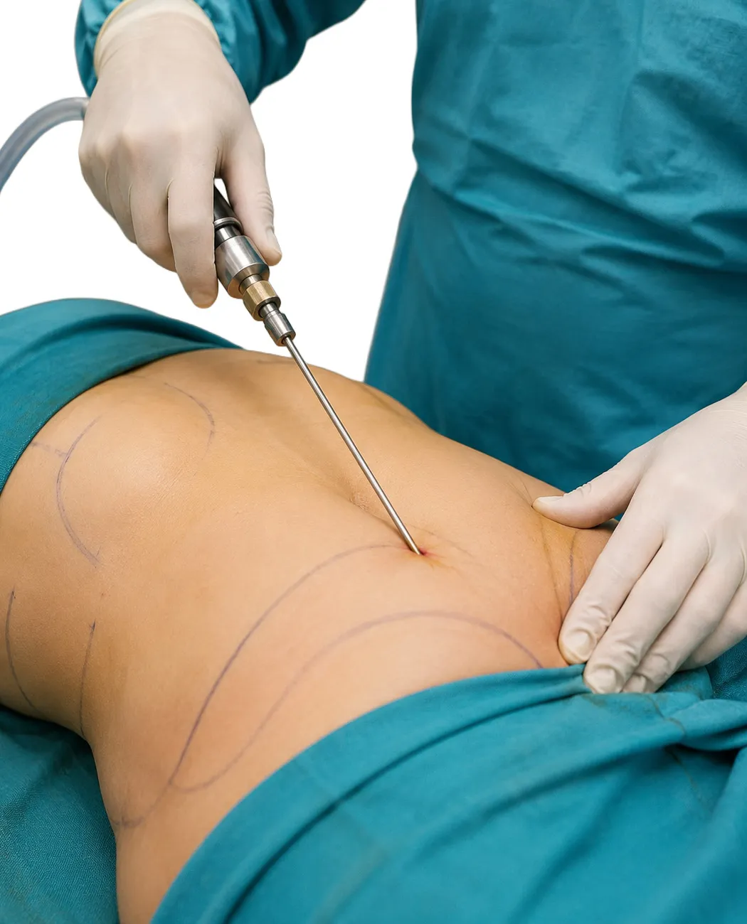 What is Liposuction Surgery?