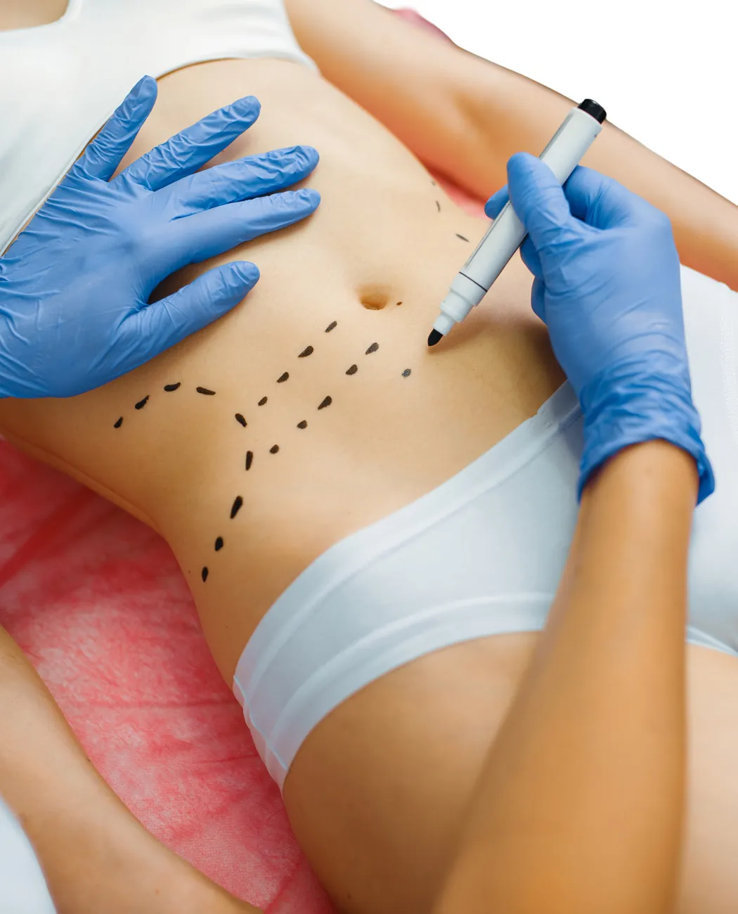 How is Mommy Makeover Surgery Performed?
