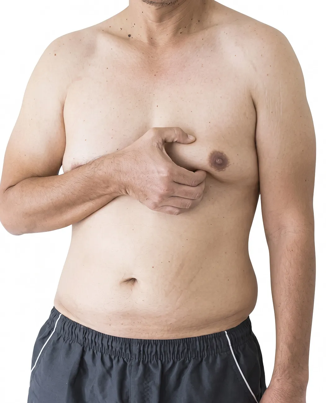 Who is an Ideal Candidate for Gynecomastia Surgery?