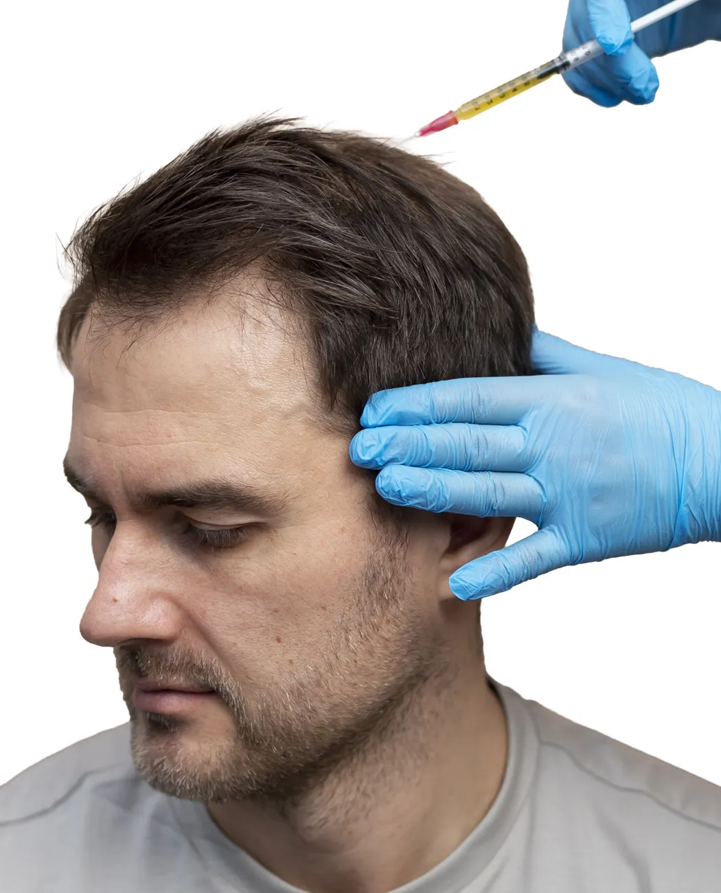 Recovery After Hair Transplant (FUE/FUT) Surgery: What to Expect
